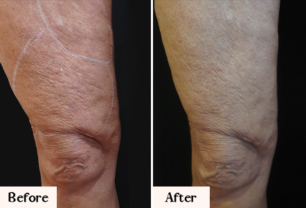 cellulite solutions nyc